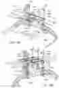 Fig. 15 - Abdominal closure method and device for ventral hernia