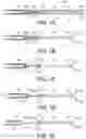 Fig. 02 - Methods and devices for controlling the size of emphysematous bullae