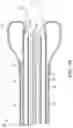Fig. 05 - STONE RETRIEVAL BALLOON CATHETER