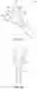 Fig. 12 - STONE RETRIEVAL BALLOON CATHETER