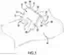 Fig. 02 - IMPLANT EXCISION AID