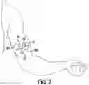 Fig. 03 - IMPLANT EXCISION AID
