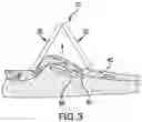 Fig. 04 - IMPLANT EXCISION AID