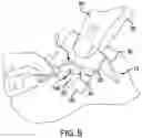Fig. 06 - IMPLANT EXCISION AID