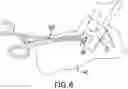 Fig. 07 - IMPLANT EXCISION AID