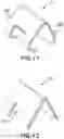 Fig. 10 - IMPLANT EXCISION AID