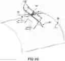 Fig. 26 - IMPLANT EXCISION AID