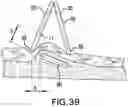 Fig. 29 - IMPLANT EXCISION AID