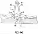 Fig. 30 - IMPLANT EXCISION AID