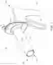Fig. 02 - Minimally invasive specimen retrieval system and methods thereof