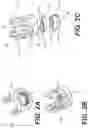 Fig. 03 - Self in-fusing pedicle screw implant
