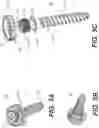 Fig. 04 - Self in-fusing pedicle screw implant