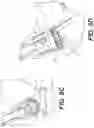 Fig. 15 - Self in-fusing pedicle screw implant