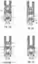 Fig. 09 - Pivotal bone anchor assembly with bottom loaded insert and pivotless retainer