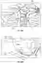 Fig. 100 - Sternal closure method and system