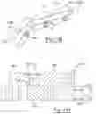 Fig. 76 - Sternal closure method and system
