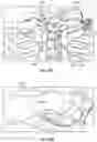 Fig. 99 - Sternal closure method and system