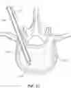 Fig. 08 - Articulating osteotome with cement delivery channel and method of use