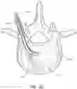 Fig. 09 - Articulating osteotome with cement delivery channel and method of use