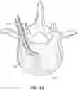 Fig. 10 - Articulating osteotome with cement delivery channel and method of use