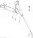 Fig. 11 - Articulating osteotome with cement delivery channel and method of use