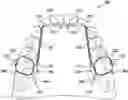 Fig. 01 - Dental arch and airway expander device and method