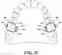 Fig. 05 - Dental arch and airway expander device and method