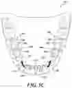 Fig. 12 - Dental arch and airway expander device and method