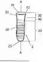 Fig. 04 - DENTAL IMPLANT
