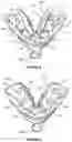 Fig. 03 - Dental framework and prosthesis