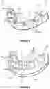 Fig. 04 - Dental framework and prosthesis