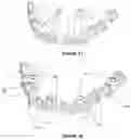 Fig. 19 - Dental framework and prosthesis