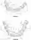 Fig. 20 - Dental framework and prosthesis