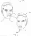 Fig. 02 - Non-Surgical Anti-Aging Denture Facelift System