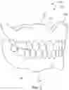 Fig. 03 - Non-Surgical Anti-Aging Denture Facelift System