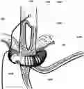 Fig. 01 - Adaptive lower esophagus sphincter augmentation