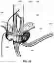 Fig. 06 - Adaptive lower esophagus sphincter augmentation