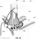 Fig. 08 - Adaptive lower esophagus sphincter augmentation