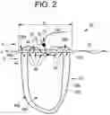 Fig. 03 - Flexible implant with adjustable coils