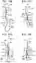 Fig. 13 - Flexible implant with adjustable coils