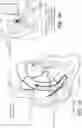 Fig. 02 - VALVED STENT FOR ORTHOTOPIC REPLACEMENT OF DYSFUNCTIONAL CARDIAC VALVE AND DELIVERY SYSTEM