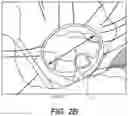 Fig. 04 - VALVED STENT FOR ORTHOTOPIC REPLACEMENT OF DYSFUNCTIONAL CARDIAC VALVE AND DELIVERY SYSTEM
