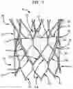 Fig. 02 - Leaflet suturing to commissure points for prosthetic heart valve