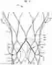 Fig. 03 - Leaflet suturing to commissure points for prosthetic heart valve