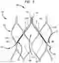 Fig. 04 - Leaflet suturing to commissure points for prosthetic heart valve