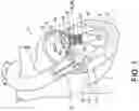 Fig. 02 - Transcatheter atrio-ventricular valve prosthesis