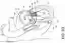Fig. 06 - Transcatheter atrio-ventricular valve prosthesis