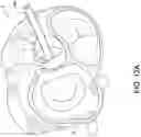 Fig. 17 - Transcatheter atrio-ventricular valve prosthesis