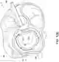 Fig. 21 - Transcatheter atrio-ventricular valve prosthesis