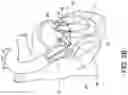 Fig. 04 - Transcatheter atrio-ventricular valve prosthesis